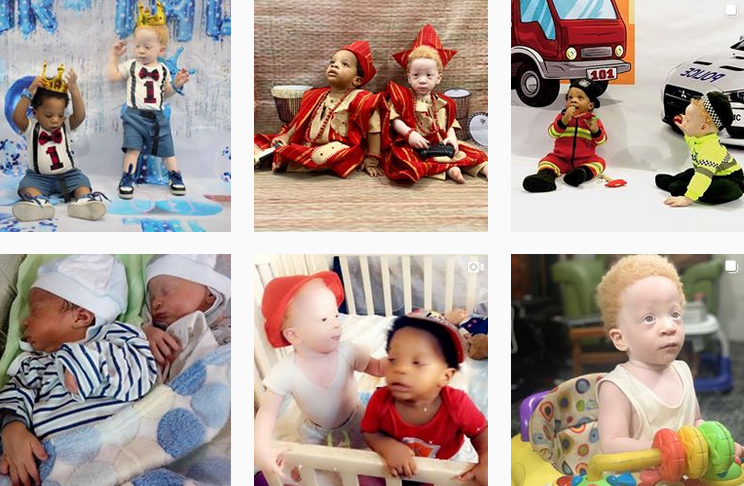 Кад је мајка РОДИЛА БЛИЗАНЦЕ зинула је од ЧУДА, а цело ОСОБЉЕ БОЛНИЦЕ трчало је да их види: ЈЕДНОЈАЈЧАНИ СУ, а нико није могао да објасни зашто је један изгледао ОВАКО (ФОТО)